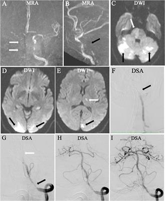 Selection of patients with acute vertebrobasilar artery occlusion for endovascular treatment by magnetic resonance imaging